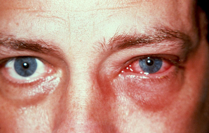 eye-infection-1.jpg